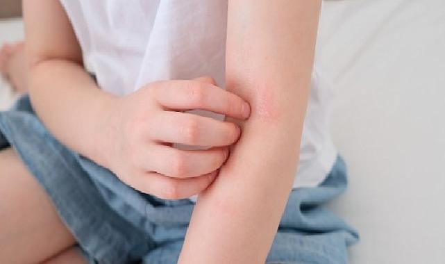 Çocuklarda ‘Alerjik Hastalıklar’ Hakkında Doğru Sanılan 8 Hatalı Bilgi!
