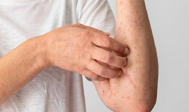 1 Ekim Dünya Ürtiker Günü: Gereksiz Besin Diyetleri Ürtikeri Tetikliyor