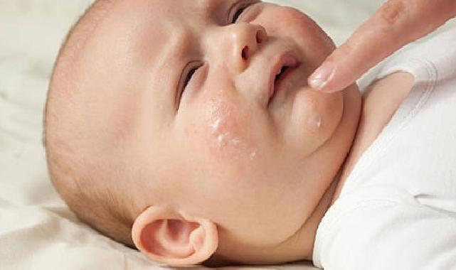 Atopik Dermatit Çocuklarda Daha Sık Görülüyor